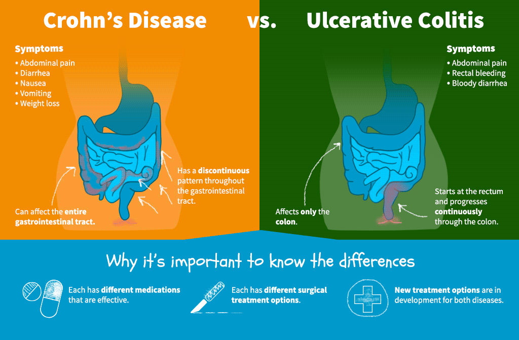 What are the symptoms of ulcerative colitis?